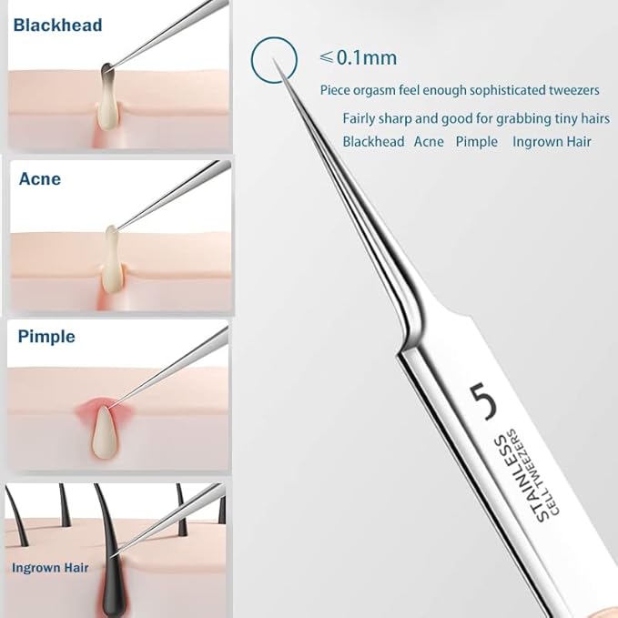 2Pcs Professional Facial Blackhead Remover Tweezers and Pimple Extractor Acne Treatment Tool for Acne Pimples Comedowns Blemishes or Splinters Removal