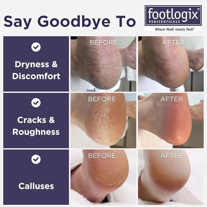 Footlogix Double-Sided Stainless Steel Foot File with Rubberized Handle – Coarse & Fine Grit Foot Exfoliator for Dry, Rough Skin | Professional Pedicure Tool | Lightweight, Easy to Clean