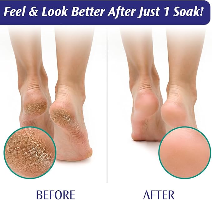 PediFix Soaking Crystals Foot Bath – 6 Packets – Therapeutic Foot Soak with Tea Tree Oil & Epsom Salt for Sore, Tired, Achy Feet