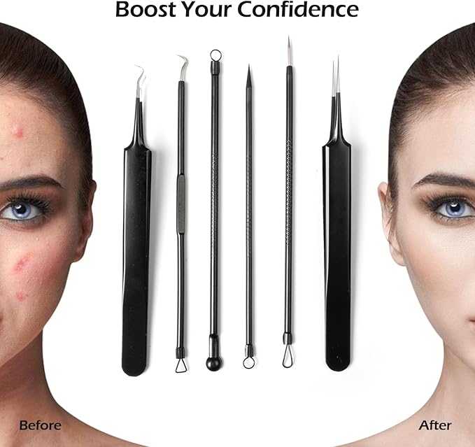 Blackhead Remover Pimple Popper Tool Kit for Nose Face Skin Blemish Extractor Tool(6 Piece Kit),Black