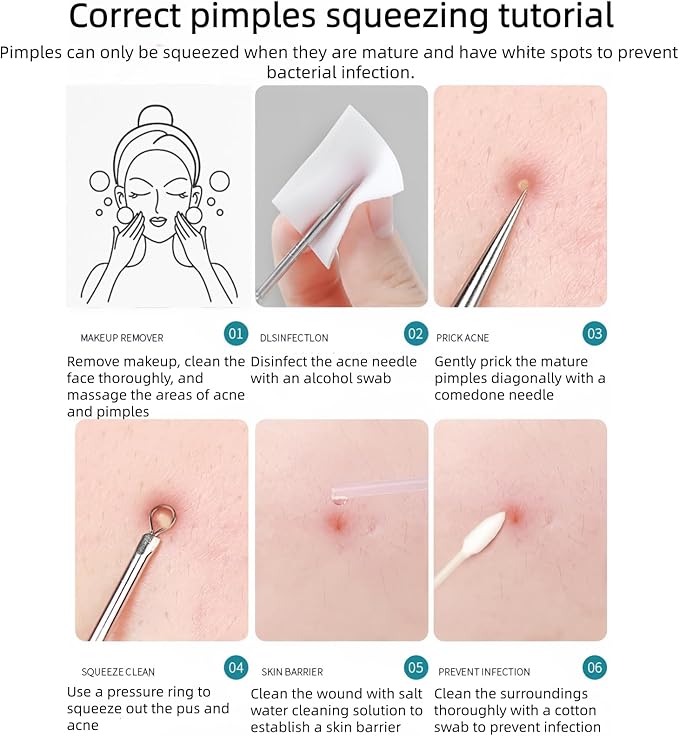 5 Pcs Blackhead Remover Comedone Extractor, Acne Removal Kit, Manual Pimple Popper Tool for Quick and Easy Removal of Pimples, Blackheads on Forehead, Facial and Nose (5 Pack)