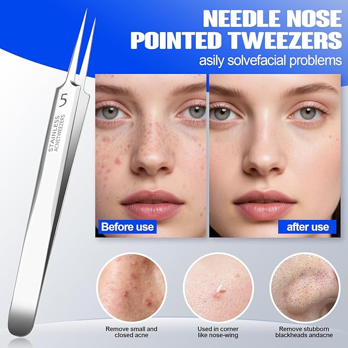 Professional Blackhead Remover Pimple Popper Tools Kit, Pore Prep Scraper, Precision Nose Blackhead Extractor Tweezers, Black Head Removal for Face Acne, Whitehead Popping Extractor, Blemish Comedone