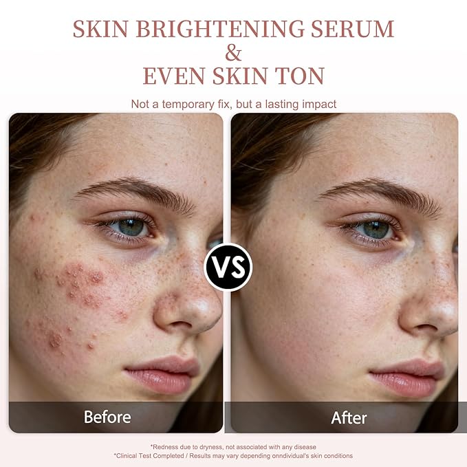 Vitamin C Serum for Face – Brightening & Anti-Aging & Wrinkle Facial Serum With Vitamin C, Sodium Hyaluronate, Vitamin E And More. Hydrating Dark Spot Corrector to Even Skin Tone & Glow, 1 fl oz
