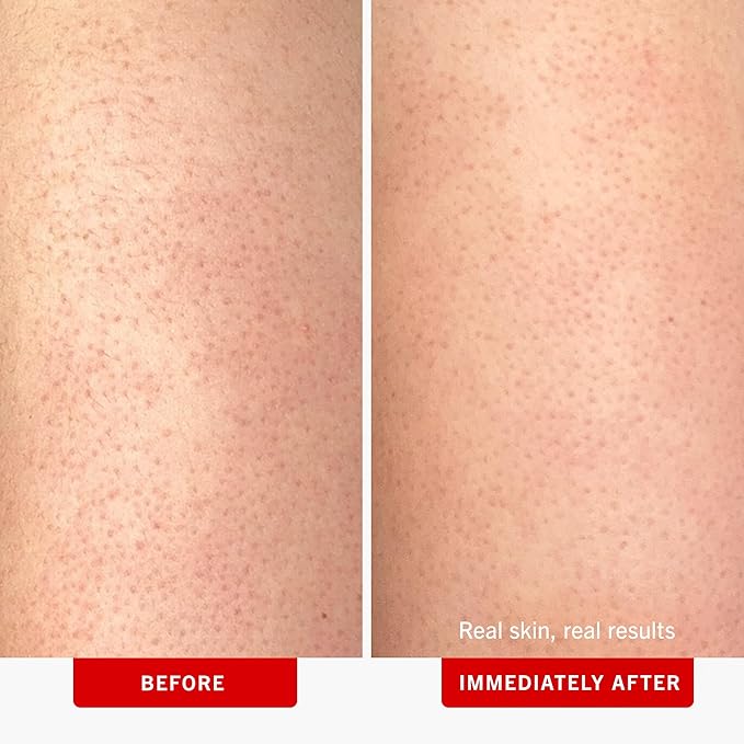 First Aid Beauty KP Bump Eraser Body Scrub Exfoliant for Keratosis Pilaris with 10% AHA 4 oz.