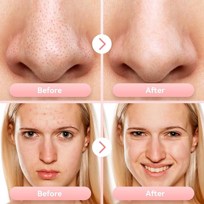 Blackhead Remover Pore Vacuum Pore Cleaner Electric Comedone Whitehead Extractor Tool-5 Suction Power-5 Probes,USB Rechargeable Blackhead Vacuum Kit for Women & Men