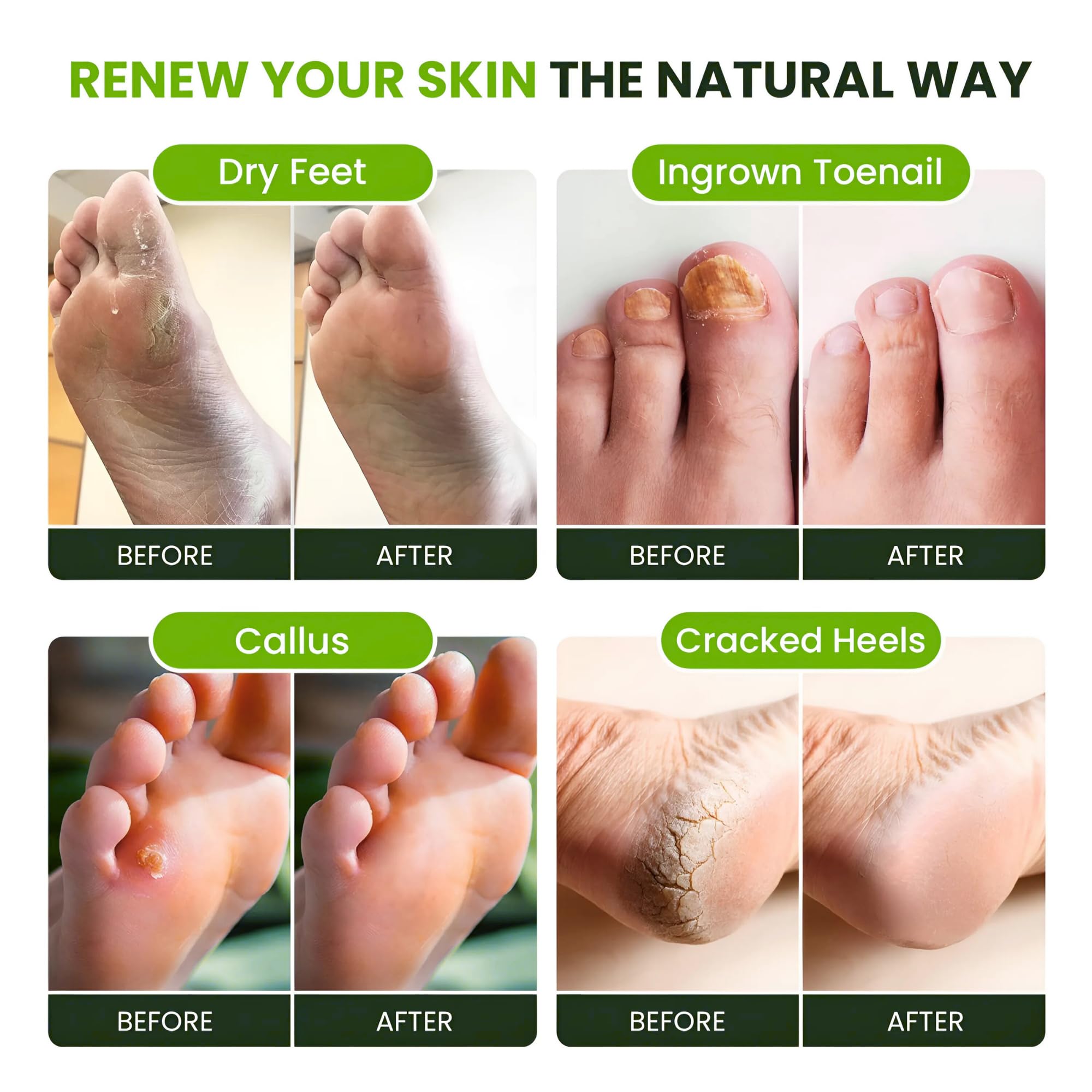 FOOT CURE Tea Tree Oil Foot Soak with Epsom Salt - Best Toenail Fungus Treatment, Athletes Foot & Softens Calluses - Soothes Sore & Tired Feet, Fungal Toe, Foot Odor Scent, Spa Pedicure (Pack of 2)