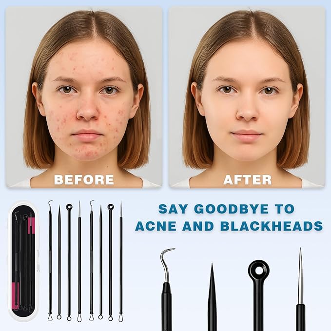 Blackhead Remover Tool Kit – 4-Piece Stainless Steel Acne & Pimple Set | Whitehead & Zit Extractor with Non-Slip Handles （2 Sets）