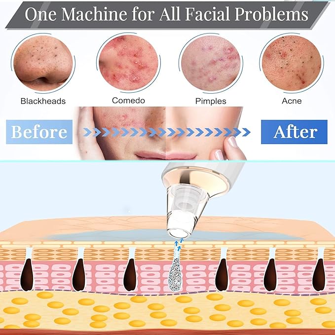 Blackhead Remover Pore Vacuum, Upgraded USB Rechargeable Facial Pore Cleaner Blackhead Removal Kit with 3 Suction Power,5 Probes Black Head Extractions Tool for Women & Men
