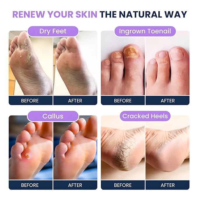 FOOT CURE Soothing Lavender Foot Spa with Epsom Salt Bath Soak – Pedicure Foot Soak Tub & Feet Massager Spa – Relaxing Scrubber & Dead Skin Remover – Ionic Foot Bath Detox for Feet Care (Pack of 1)
