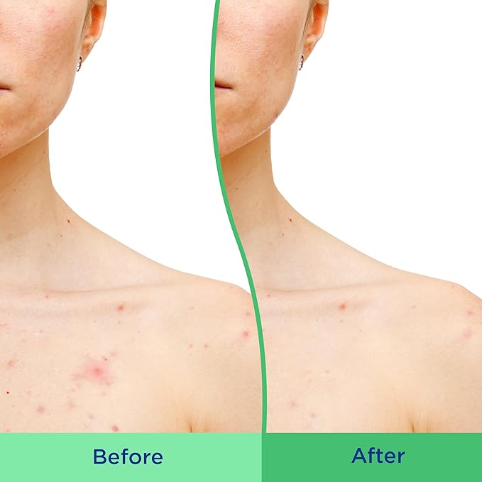 Differin Acne Body Scrub, Salicylic Acid for Back & Chest Treatment, 8 oz