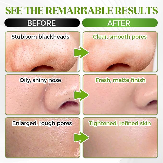Tiepetly Blackhead Remover Strip, Nose Pores Strips, Deep Cleansing Strawberry Nose, Effective Control Of Oily Skin, Clear Pores, for All Skin Types