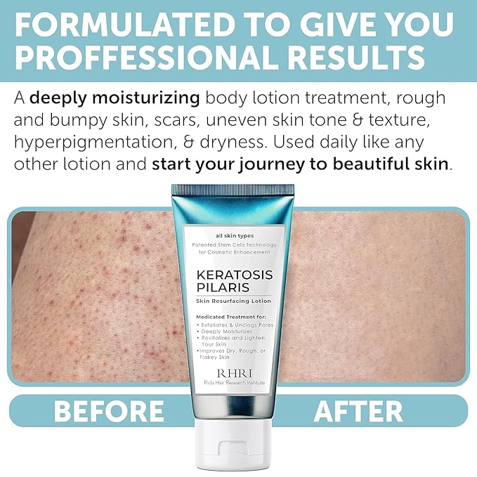 KP Bump Eraser Body Scrub with 10% AHA | Keratosis Pilaris Treatment | Bump Eraser Body Scrub | Clears Strawberry Legs | Soothes Redness, Dryness & Flaky Skin