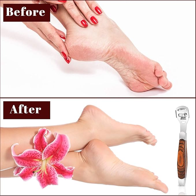 Callus Shaver, Foot Shaver Callus Remover for Feet Hand Care with Foot File, 10pcs Blades, Foot File Head and Dead Skin Storage Cover (15Pcs in Total)
