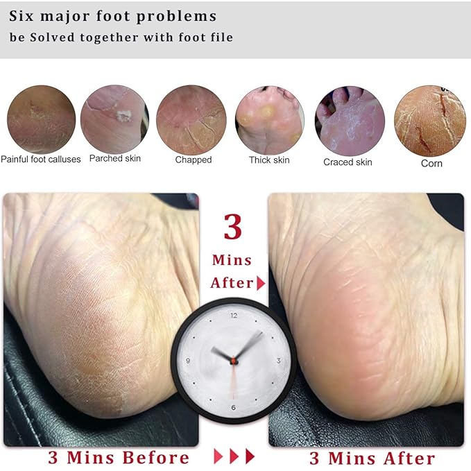 Kinepi Callus Remover Foot File & Foot Scrubber, Pumice Stone for Feet