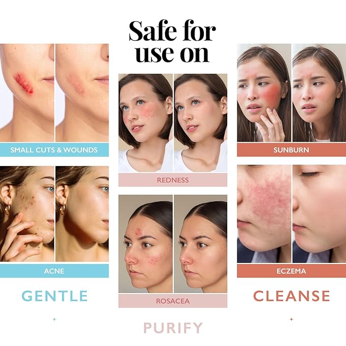 Aquia Hypochlorous Acid Spray for Face and Skin; Facial Cleanser | 4oz Face Mist Hypochlorous Acid Spray for Skin, Acne, Rash, Eczema, Wound Antimicrobial Facial Cleanser Acne Sprays; Smart Skincare