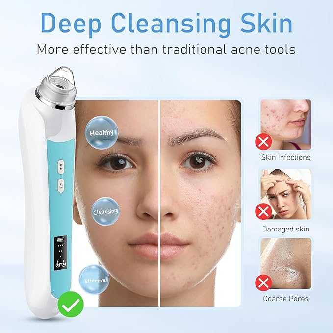 Blackhead Remover Vacuum