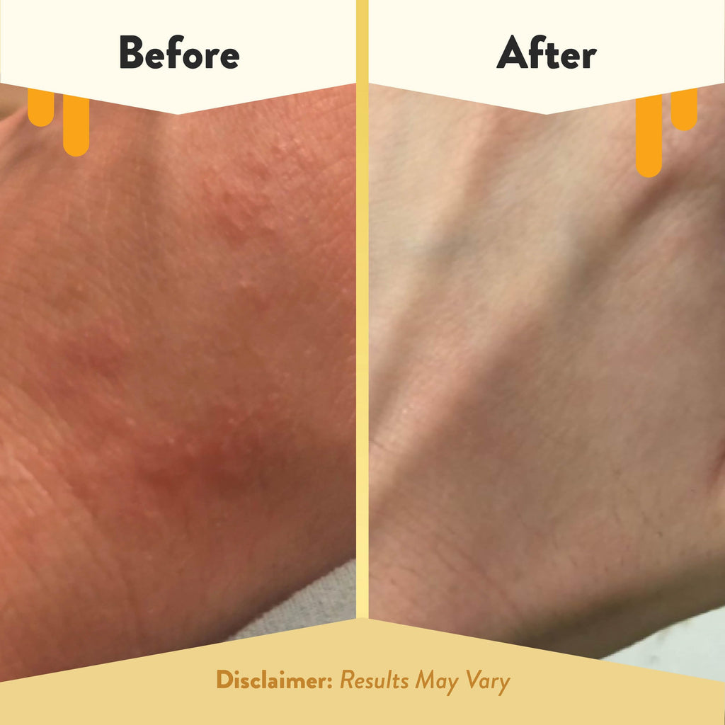 ECZEMA HONEY Oatmeal Body Lotion, Natural Dry Skin Repair (16 Oz)