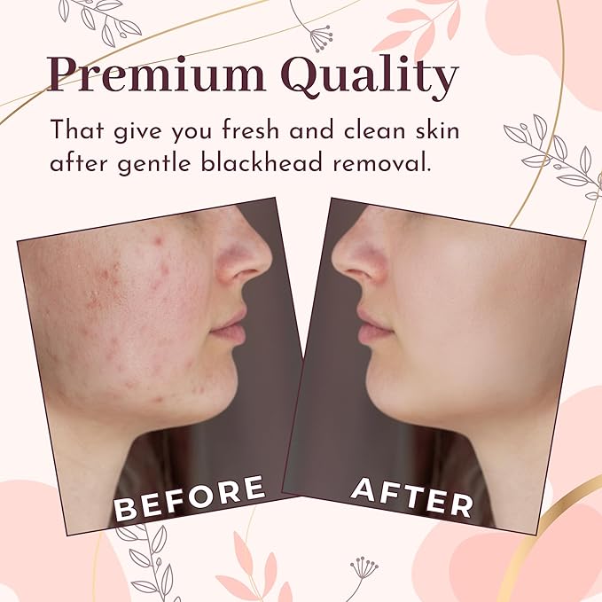 Blackhead Remover Professional Skincare Spot Treatment Blackhead Remover Tool for Blemish Comedone Whiteheads Pimple Popper with Double Sided Soft Touch and Anti-Slip Design