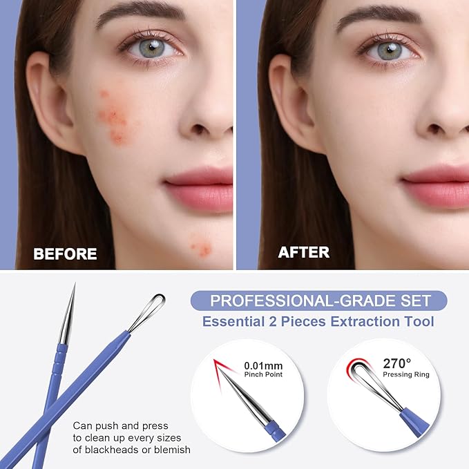 Teenitor Pimple Extractor Acne Treatment Surgical Grade Blackhead Comedone Removal 2-in-1 Popper Tool (Blue)