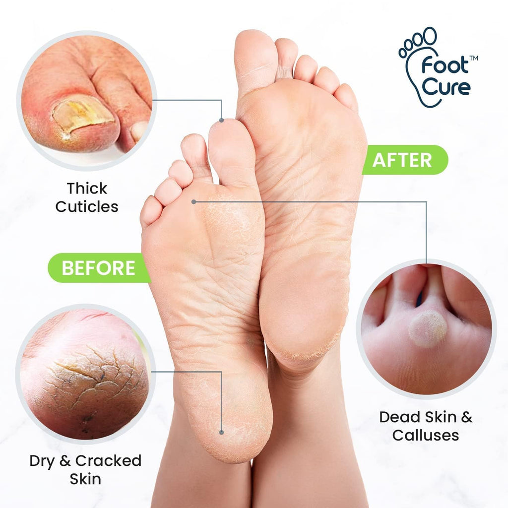 Foot Callus Remover Pedicure Set – Epsom Salt Foot Soak & Callus Remover Gel, Antifungal Cream and Feet Exfoliator for Dead Skin, Pedicure Tools for Feet at Home, Made in USA (4 Piece)
