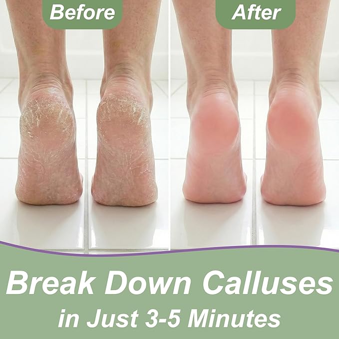 Dr. Entre's 16oz Callus Remover Gel: Extra Strength Value Size, Callus Remover for Feet, Pedicure Tools Supplies, Dead Skin Remover, Foot Care