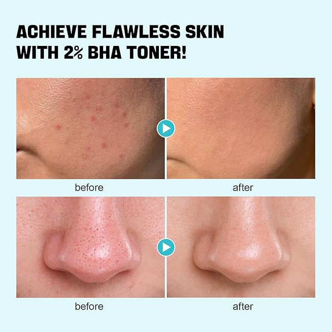 ZealSea Salicylic Acid Toner, Blackhead Remover, Pore Minimizer Oil Control