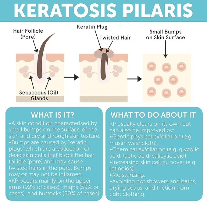 KP Bump Eraser Body Scrub with 10% AHA | Keratosis Pilaris Treatment | Bump Eraser Body Scrub | Clears Strawberry Legs | Soothes Redness, Dryness & Flaky Skin