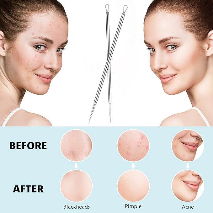 Titanium Lancet Pimple Extractor Tool, Blackhead Milia Remover, 2Pcs with Box