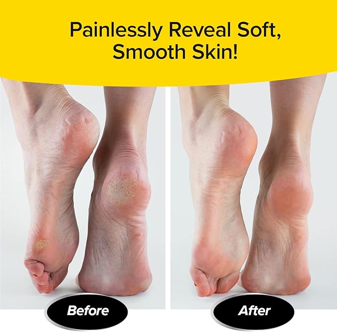 PedEgg Foot File, Painless Callus Remover, Mess-Free, As Seen on TV