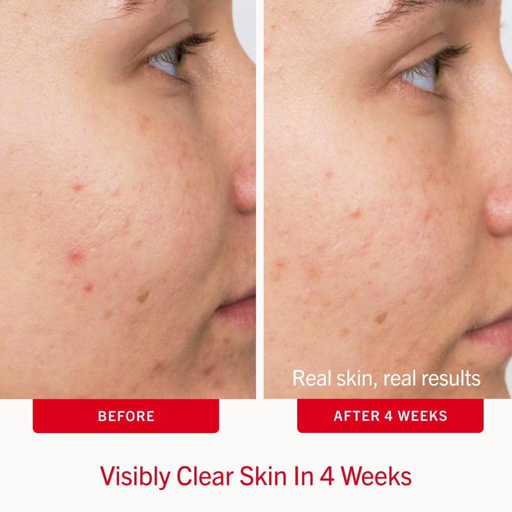 First Aid Beauty Acne Treatment Pads, 2% Salicylic Acid, 60 ct