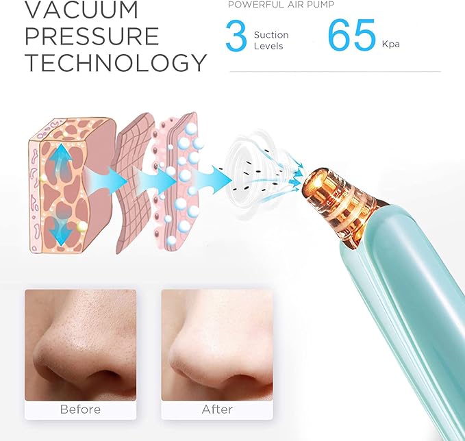Blackhead Remover Pore Vacuum Cleaner - Upgraded Facial Pore Cleaner - Electric USB Pore Vacuum with 5 Probes - Upgraded Blackhead Suction Tool - Blackhead Remover Kit