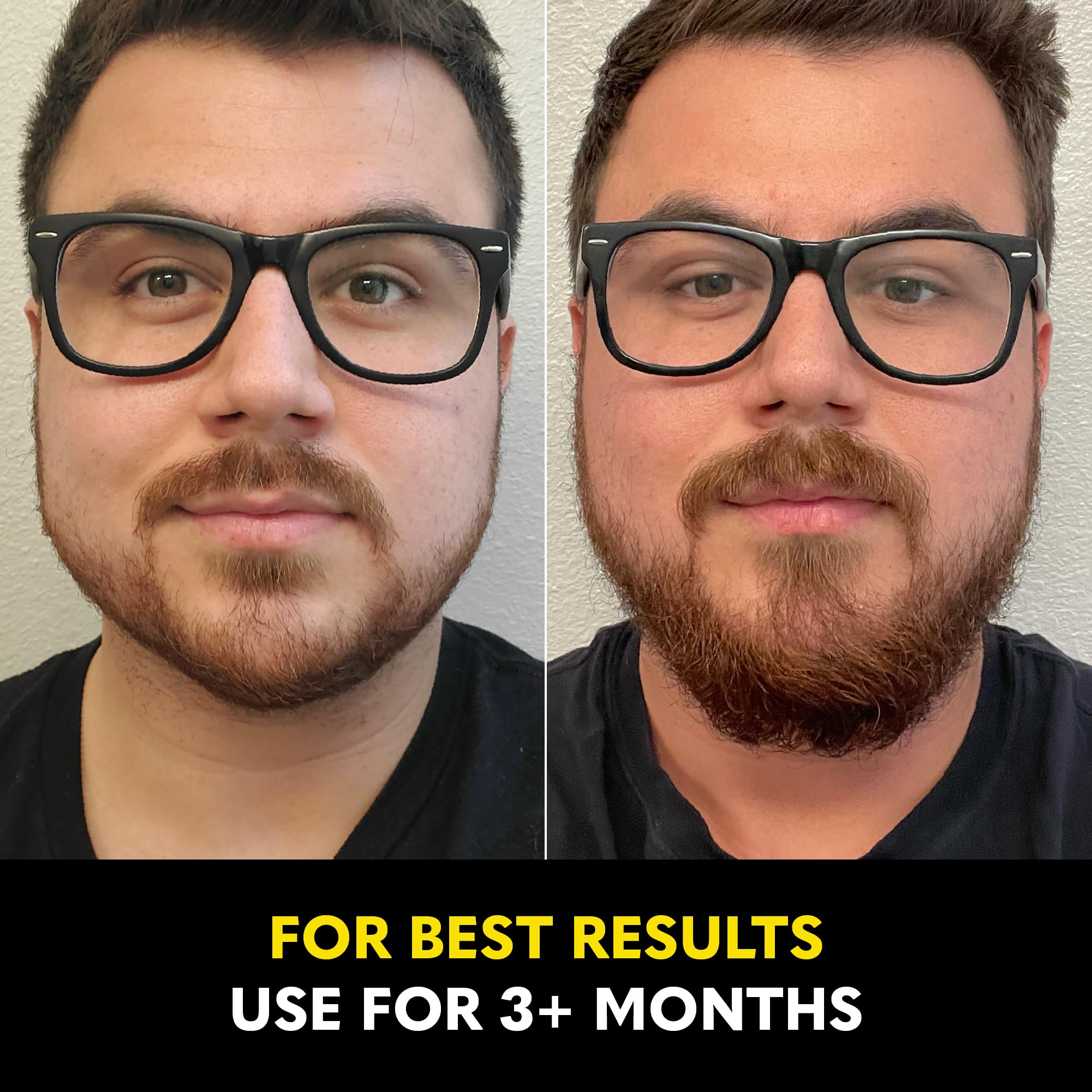 The Beard Club - Beard Growth Oil with Natural Castor & Avocado to Grow Thicker, Fuller Facial Hair, Fill in Patches and Stimulate Healthier Facial Hair Growth