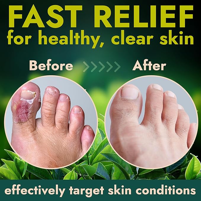 Antifungal Foot Powder with Miconazole Nitrate 2% & Tea Tree Oil for Foot Fungus Treatment | Soothes Itchy Skin, Controls Odor & Prevents Reinfection | Antifungal Powder for Athlete’s Foot | 3 of 3