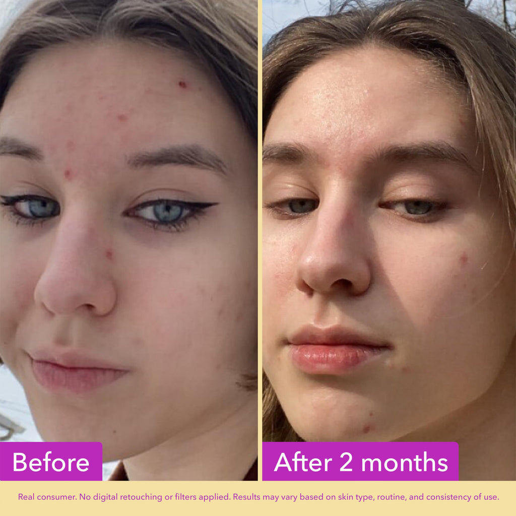 Good Molecules Niacinamide Serum Pack 3 – 30 ml Each (Total 90 ml) | 10% Niacinamide Serum to Target Blemishes, Uneven Skin Tone & Enlarged Pores