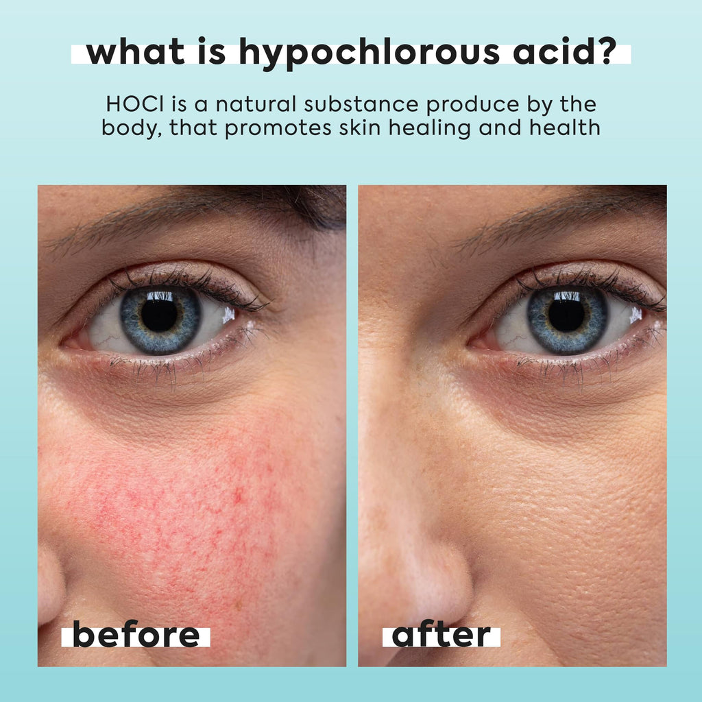 Hypochlorous Acid Spray for Face & Body - 3.4 fl oz 0.02% HOCL - Helps Reduce Redness and Breakouts - Travel Size Hypochlorous Spray - Multi-Purpose Topical Facial Skin Repair - pH-Balancing Toner