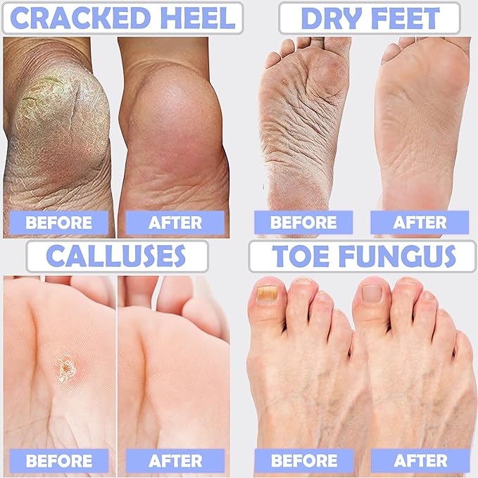 Tea Tree Oil Foot Soak with Epsom Salt: For Itchy Feet, Pedicure, Smelly Odor, Therapy, Softens Calluses, 16 oz