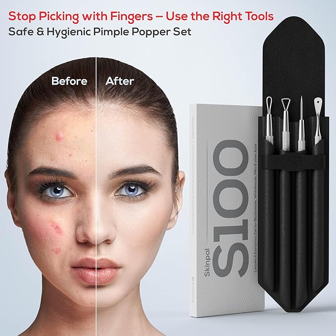 Suvorna Pimple Popper Tool Kit & Milia Remover, 4-Piece Stainless Steel Blackhead Extractor, Whitehead & Comedone Extractor with Lancets for Facial Extraction