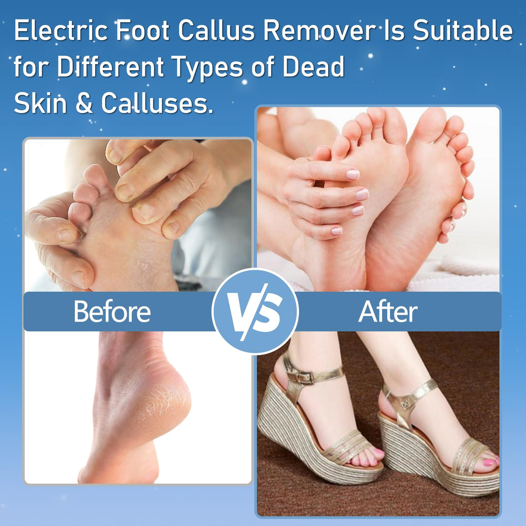 Electric Foot Callus Remover Waterproof，17 in1 Callus Remover for Feet