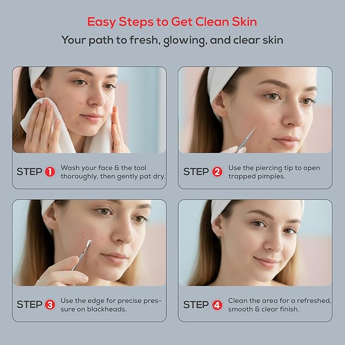 Suvorna Milia Remover, Milia Extractor, Acne Needle, Cyst Removal, Blackhead and Whitehead Removal, Pimple Popper Tool, Pimple Extractor, Blemish Remover Tool and Comedone Extractor.