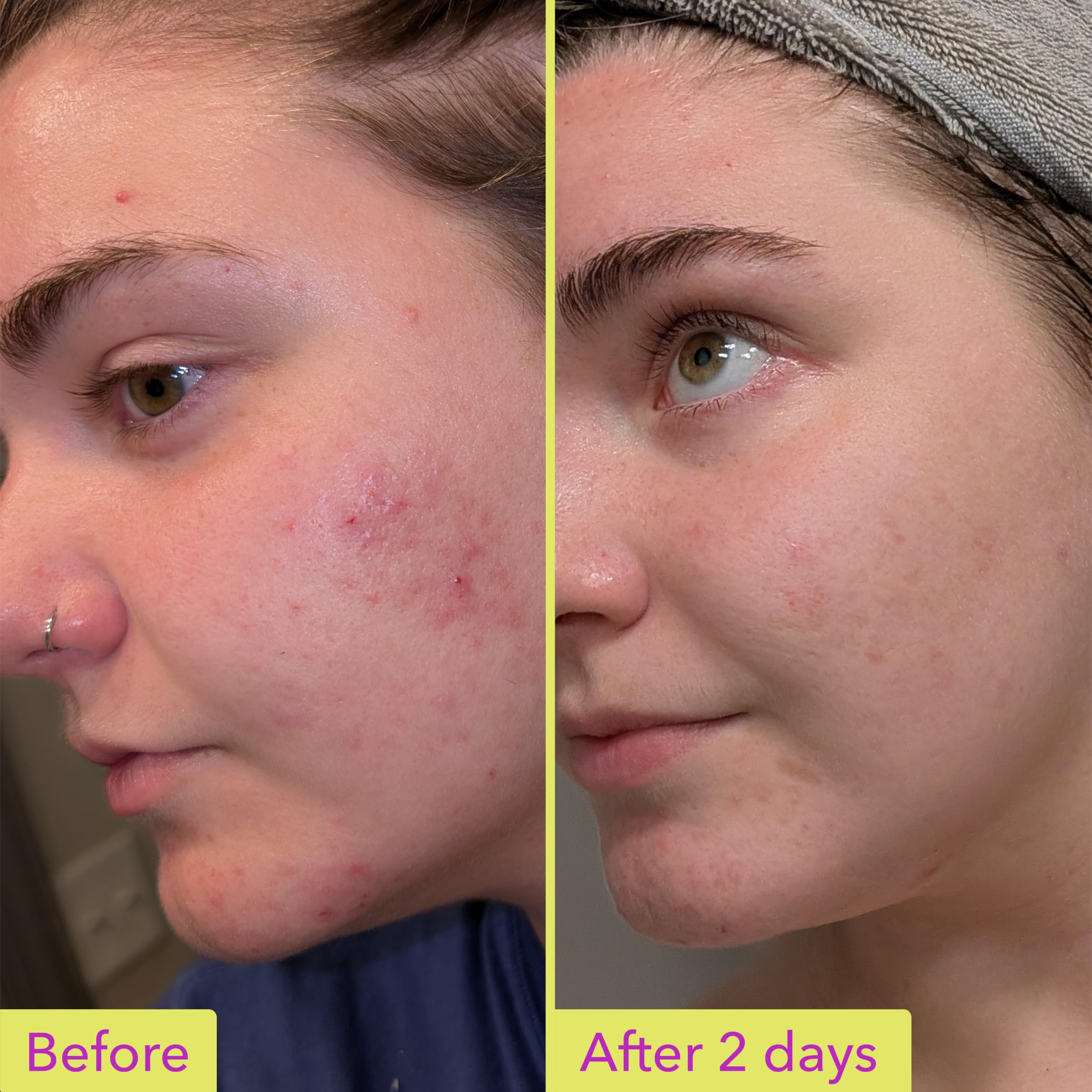 Good Molecules 10% Azelaic Acid Treatment for Face – Blurs Facial Redness & Evens Skin Tone – Brightens the Look of Dark Spots & Refines Texture – Vegan & Fragrance-Free Skincare (30ml / 1.01 fl oz.)