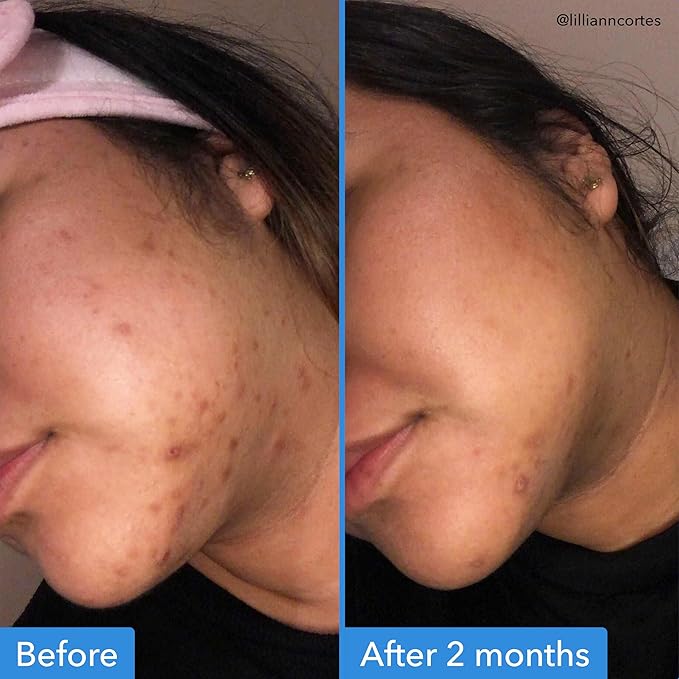 Good Molecules Discoloration Correcting Serum - Serum to Target Dark Spots and Discoloration - Skin Care for Face, 1 fl oz