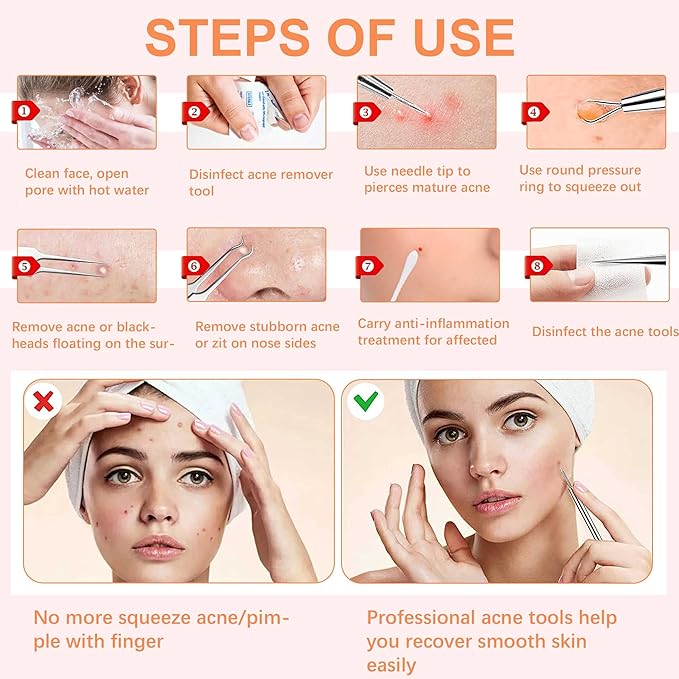 Blackhead Tweezers, Milia Remover,Ingrown Hair Tweezers