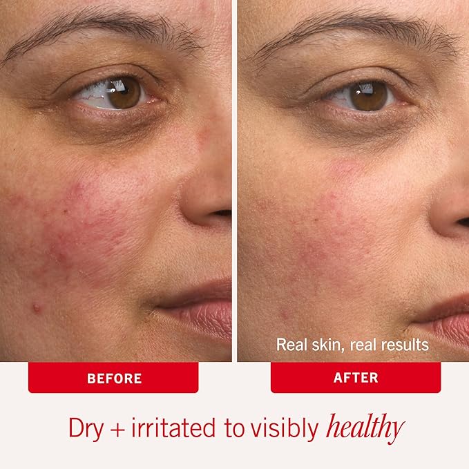First Aid Beauty - Ultra Repair Cream - Intense Hydration Face & Body Moisturizer - Whipped Colloidal Oatmeal Clinically Proven to Strengthen Skin Barrier in 7 Days - Helps Relieve Eczema, 6 oz