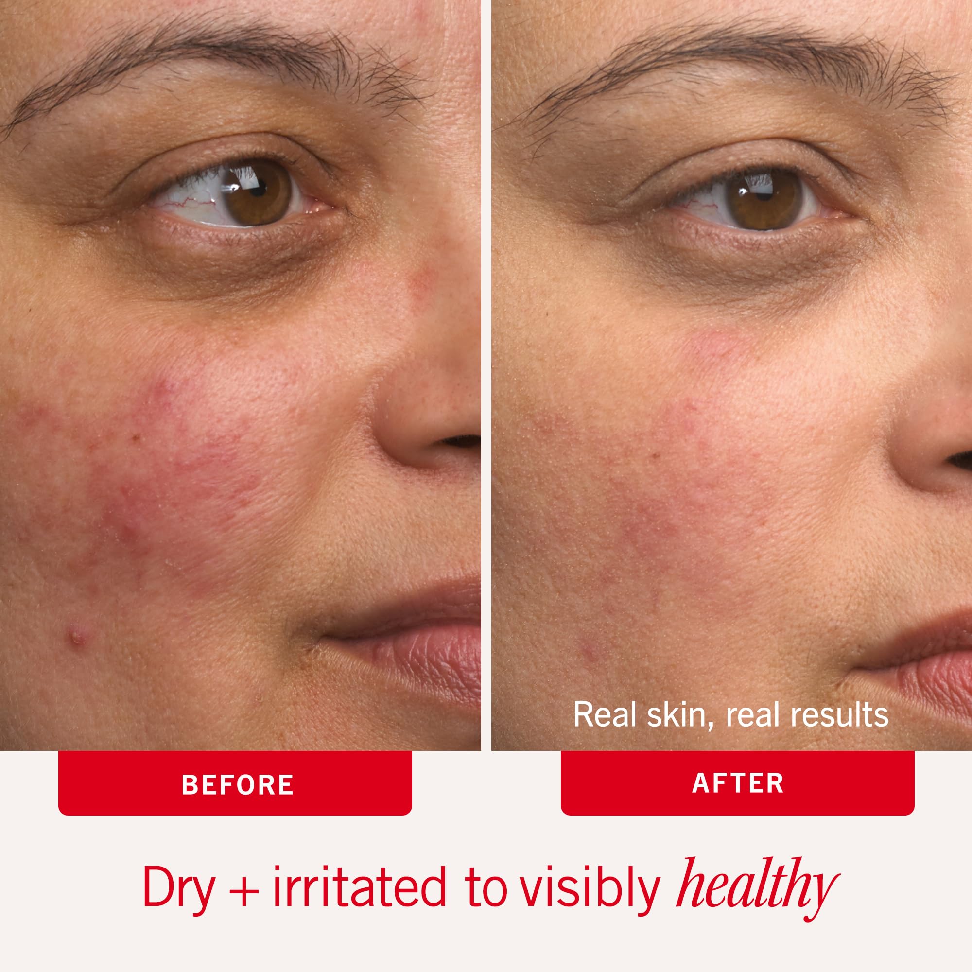 First Aid Beauty Ultra Repair Cream, Intense Hydration - Clinically Tested Face & Body Moisturizer with Colloidal Oatmeal - Supports Eczema & Dry Skin Barrier Repair - Fragrance Free - 6 oz