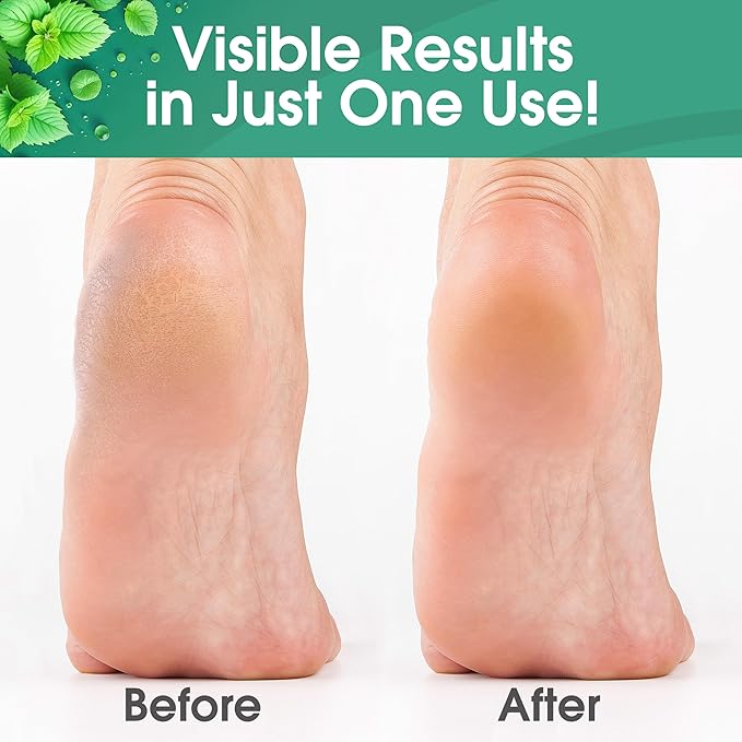 DeEnti Callus Remover for Feet, Extra Strength Foot Callus Remover Gel, 16oz Salon Grade Home Pedicure Supplies for Dry Skin, Cracked Heel, Professional Strength Foot Care, Cool Mint