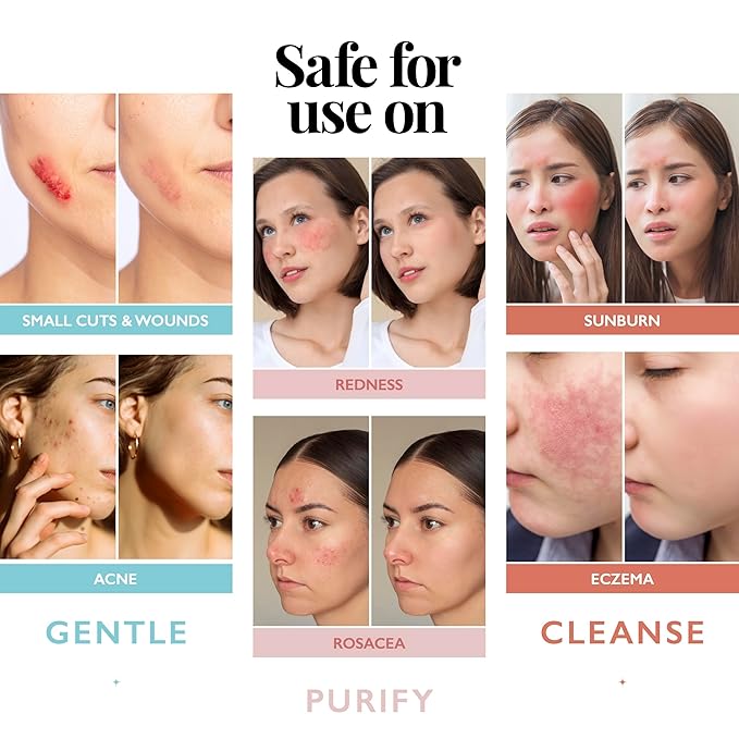 Hypochlorous Acid Spray for Face and Skin; Facial Cleanser | 8oz Face Mist Hypochlorous Acid Spray for Skin, Acne, Rash, Eczema, Wound | Antimicrobial Facial Cleanser Acne Sprays; Smart Skincare